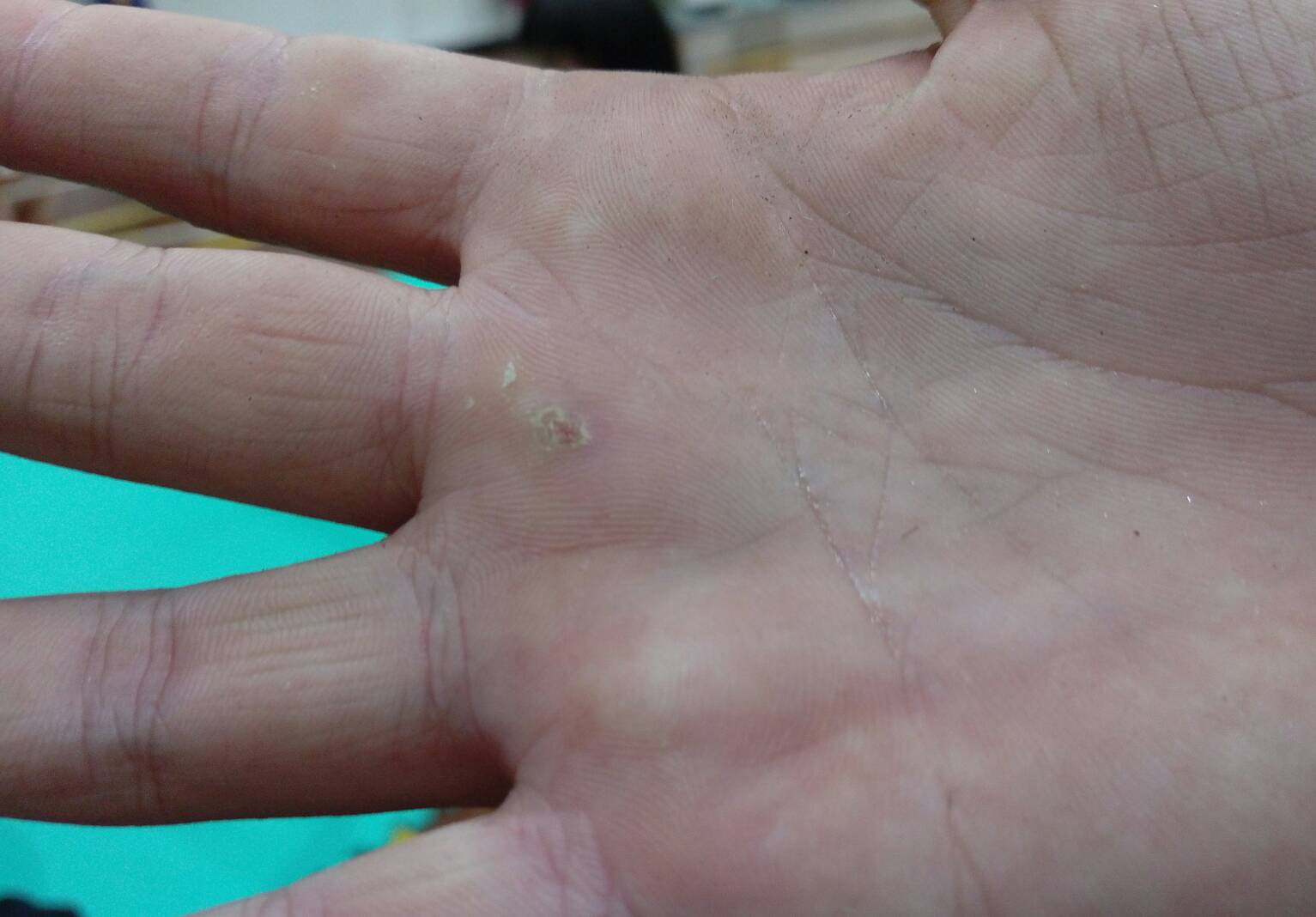 就算手掌磨破皮，包紮後継續練習