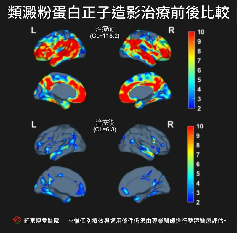 失智新藥「凍結」病程!羅東博愛醫院病友會陪伴患者守住美好時光