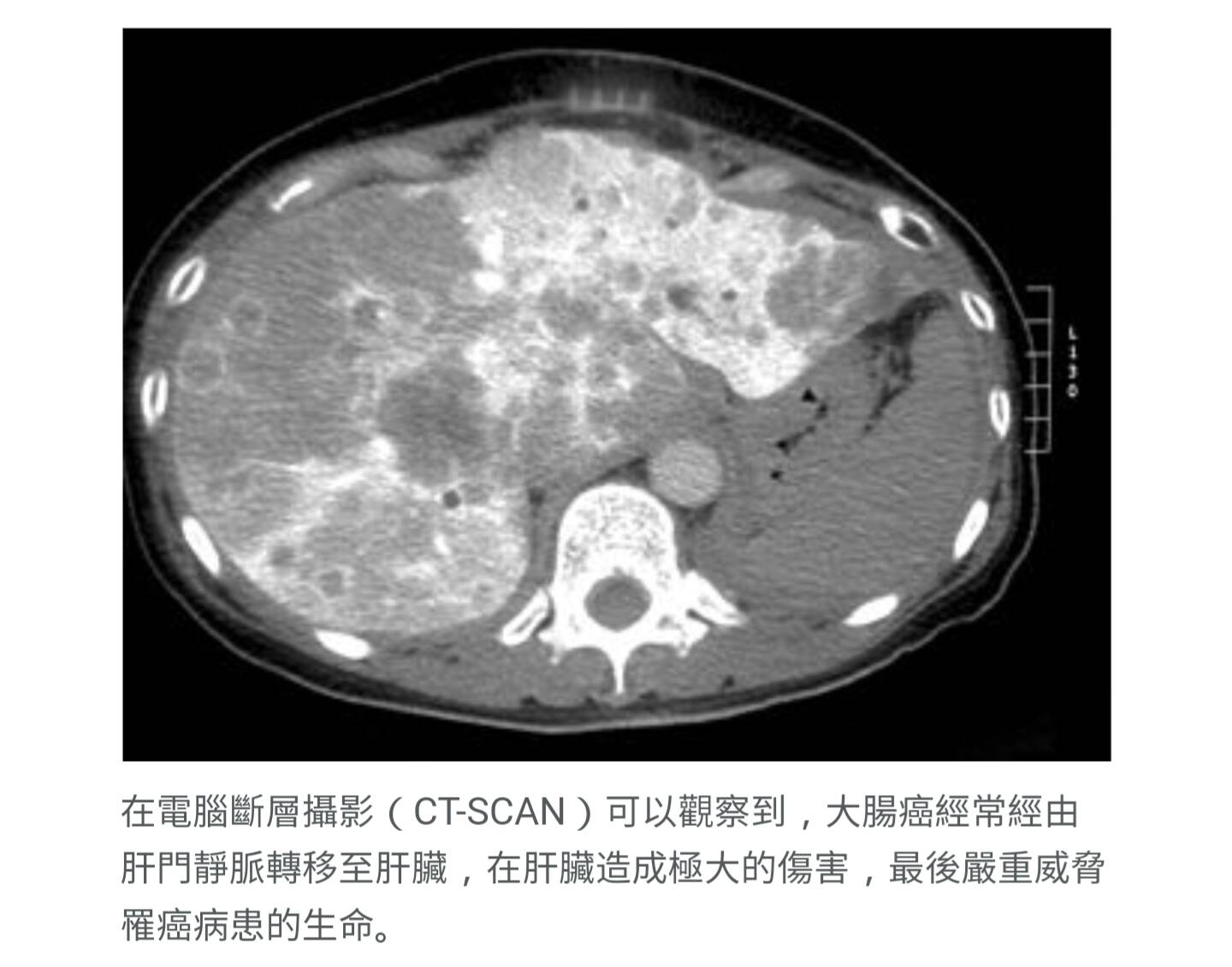 大腸癌與遺傳有關 三等親家屬應儘早做預防性檢查