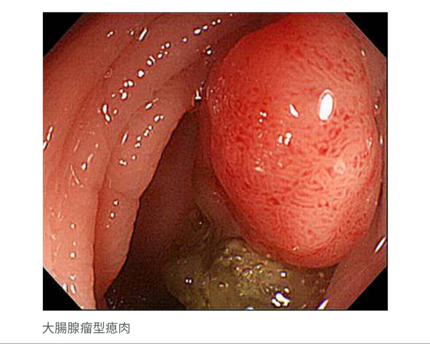 大腸癌與遺傳有關 三等親家屬應儘早做預防性檢查