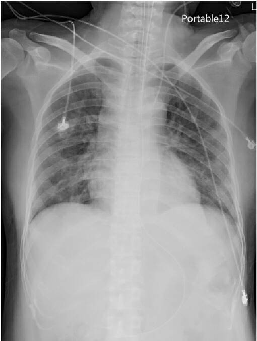 在接受治療後，原肺部發炎的泛白已消失無蹤(示意圖)