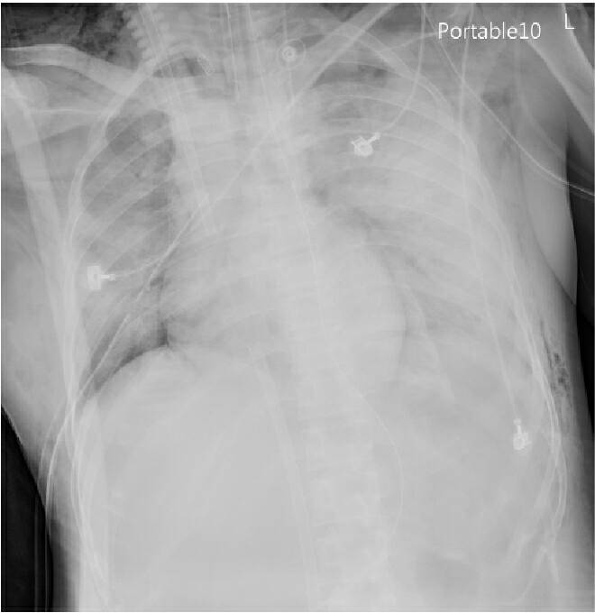  婦人的X光顯示肺部已大片泛白嚴重浸潤、衰竭(示意圖) 
