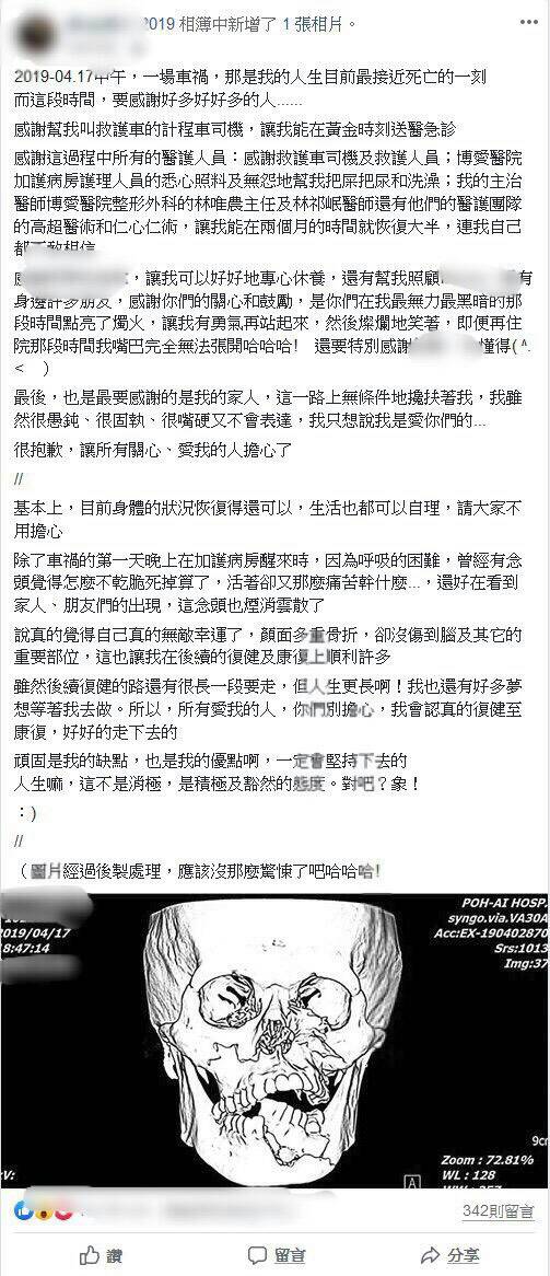 全臉骨折巧手重建 患者讚嘆醫師巧手比修圖軟體還強