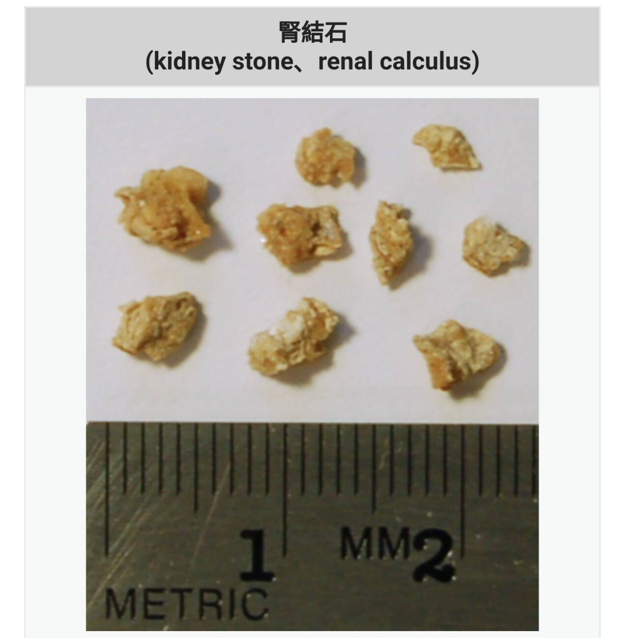 結石態樣三