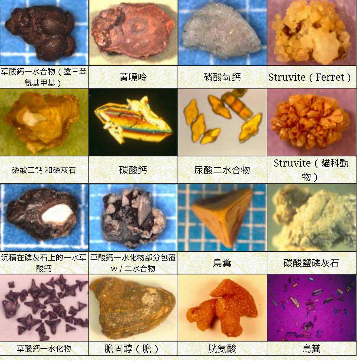 結石態樣圖片二(圖片來源維基百科)