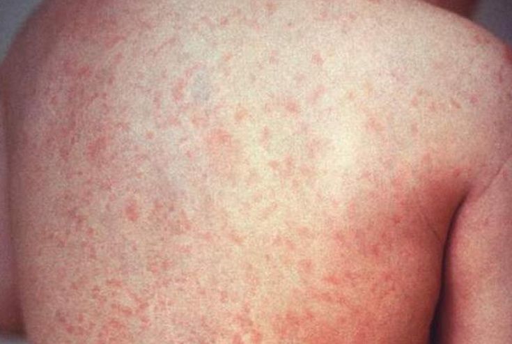 女麻疹個案傳染期曾至宜蘭  請可能接觸者自主健管18天
