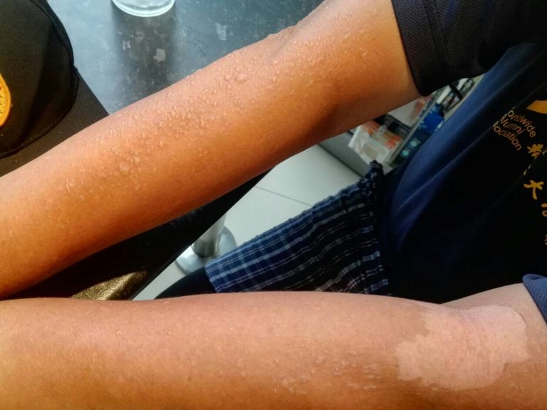 秋老虎瘋鐵馬  慎防曬傷起水泡