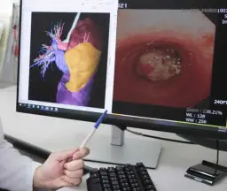單孔胸腔鏡手術無須切開胸骨 江姓男子肺腺癌術後重拾健康